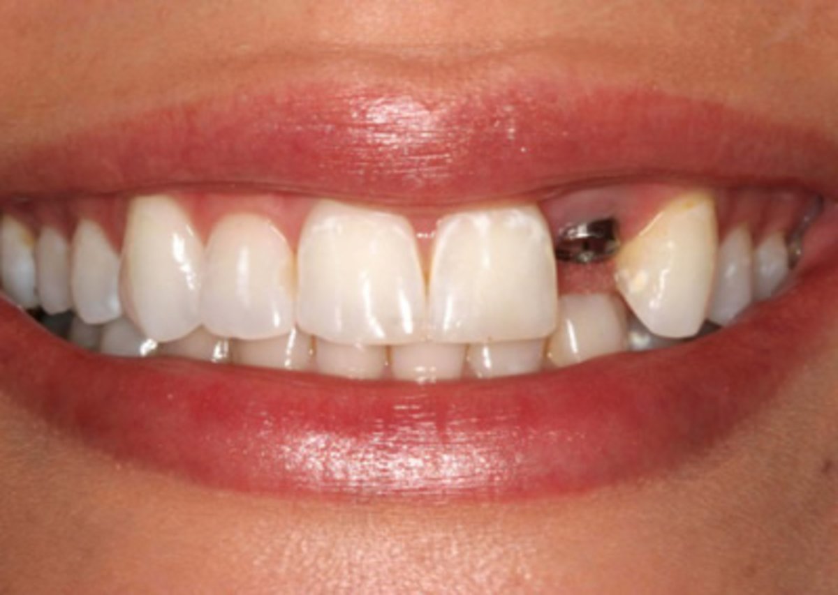 Những ảnh hưởng của việc mất răng số 2? Nha khoa Thùy Anh