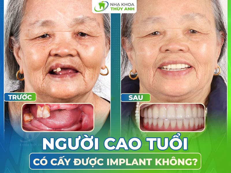 Trồng răng implant cho người già có được hay không?