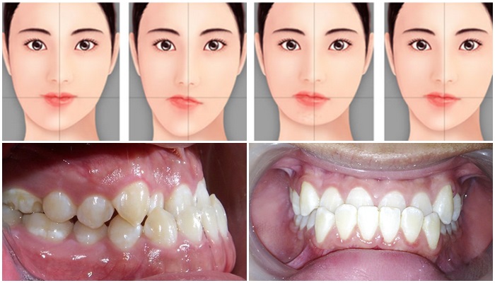 Có những phương pháp nào để điều chỉnh lại tình trạng 2 hàm răng không chạm nhau?
