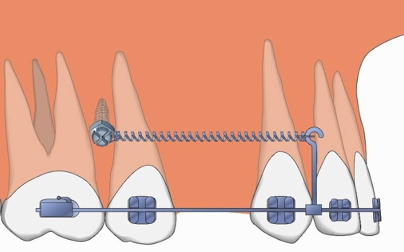 Cắm vis trong chỉnh nha có thốn như lời đồn không? Nha khoa Thùy Anh ...
