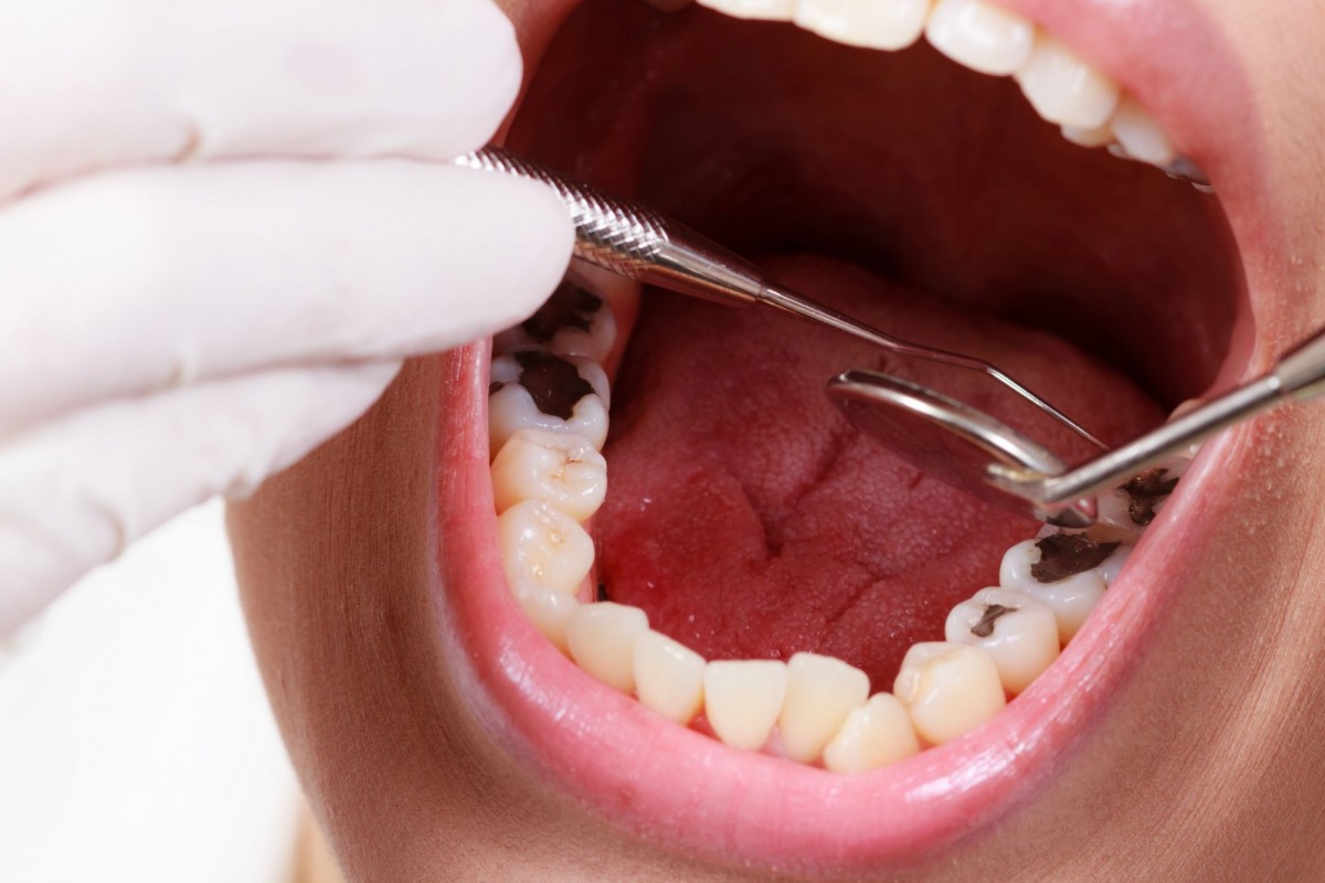 Nguyên nhân gây đau răng phổ biến bạn cần nắm rõ – nha khoa Thùy Anh