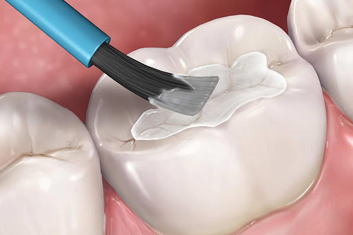 Các trường hợp cần trám răng và quy trình thực hiện – nha khoa Thùy Anh