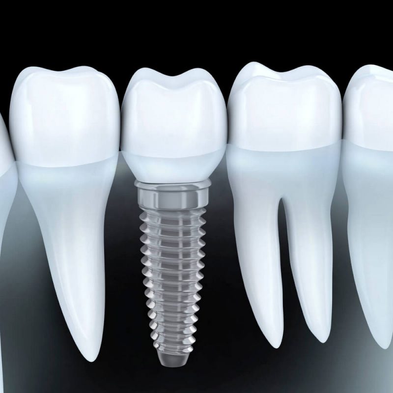 Tại sao trồng răng implant đắt hơn so với bắc cầu răng sứ? Nha khoa Thùy Anh