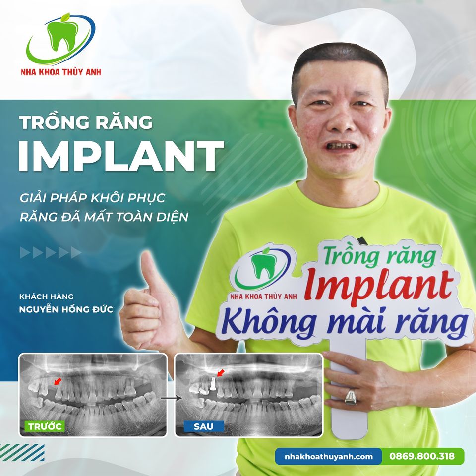 Hỏi đáp: Trong và sau khi trồng răng implant có đau hay không?