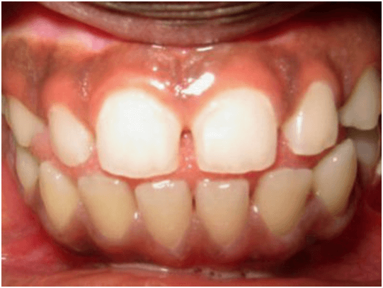 Hậu quả của việc đặt lưỡi sai – Đi tìm tư thế đúng của lưỡi