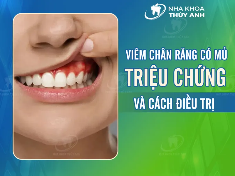 Viêm chân răng có mủ: Nguyên nhân, dấu hiệu và cách điều trị