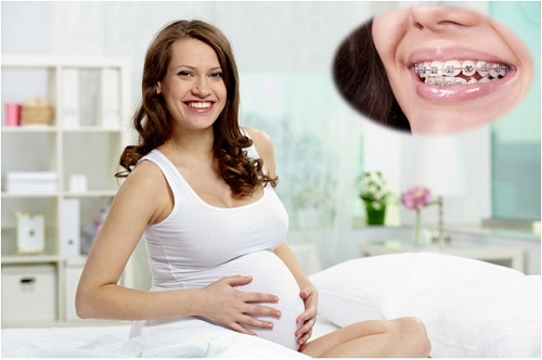 Niềng răng khi mang thai