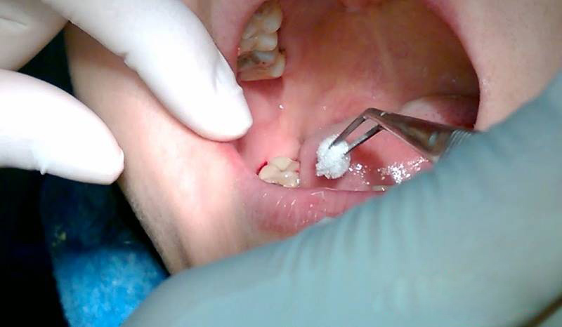 Tại sao vết phẫu thuật sau khi nhổ răng khôn lại chảy máu quá nhiều?
