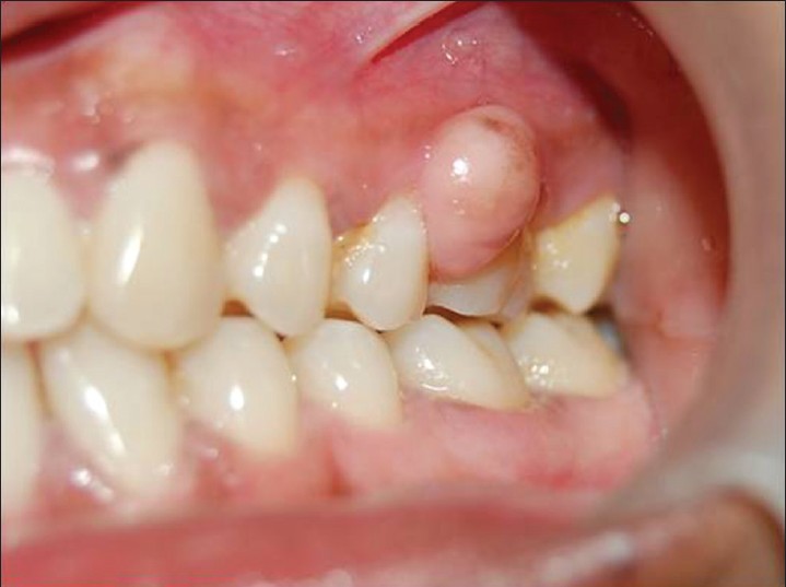 Tuyệt đối không được chủ quan trước hiện tượng sưng mộng răng – nha khoa Thùy Anh