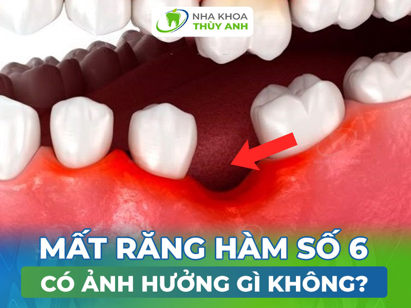 Mất răng số 6 có ảnh hưởng gì không? Hậu quả bạn cần nắm rõ