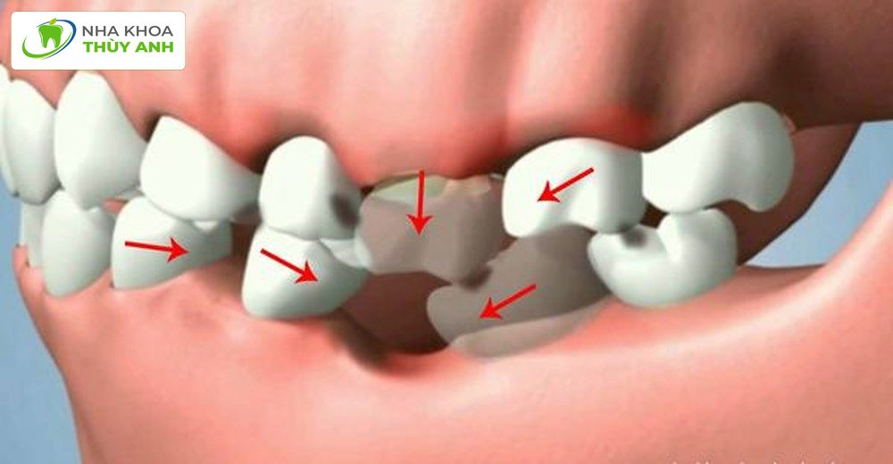 Mất chân răng nên làm gì? Giải pháp phục hình hiệu quả