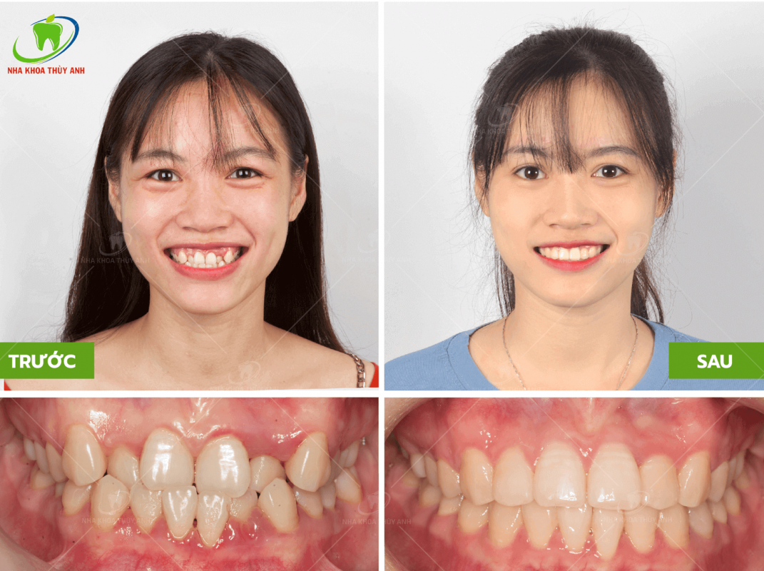 Có ai nói răng khểnh là khuyết điểm không đẹp? Chúng tôi sẽ cho bạn thấy răng khểnh cũng có thể rất quyến rũ và đẹp mắt. Hãy xem hình ảnh mà chúng tôi chia sẻ để khám phá tính độc đáo của loại răng này.