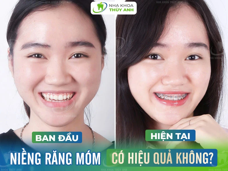 Niềng răng móm có hiệu quả không?