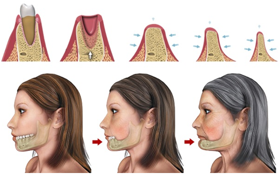 Liệu việc niềng răng có thể làm tăng nguy cơ cho xương hàm mỏng?
