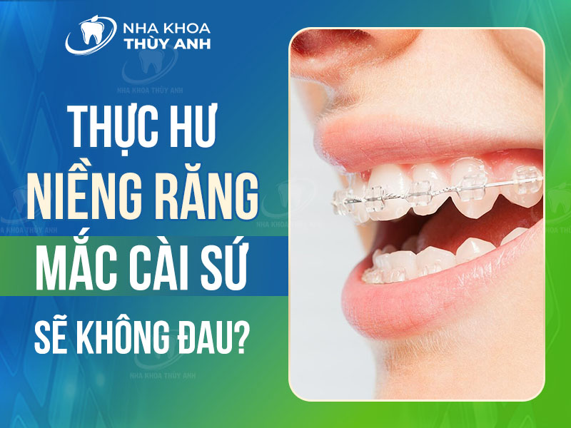 Thực hư vấn đề: Niềng răng mắc cài sứ sẽ không đau?