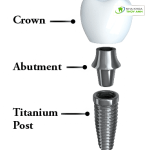 lam-the-nao-de-trong-implant-gia-re-2