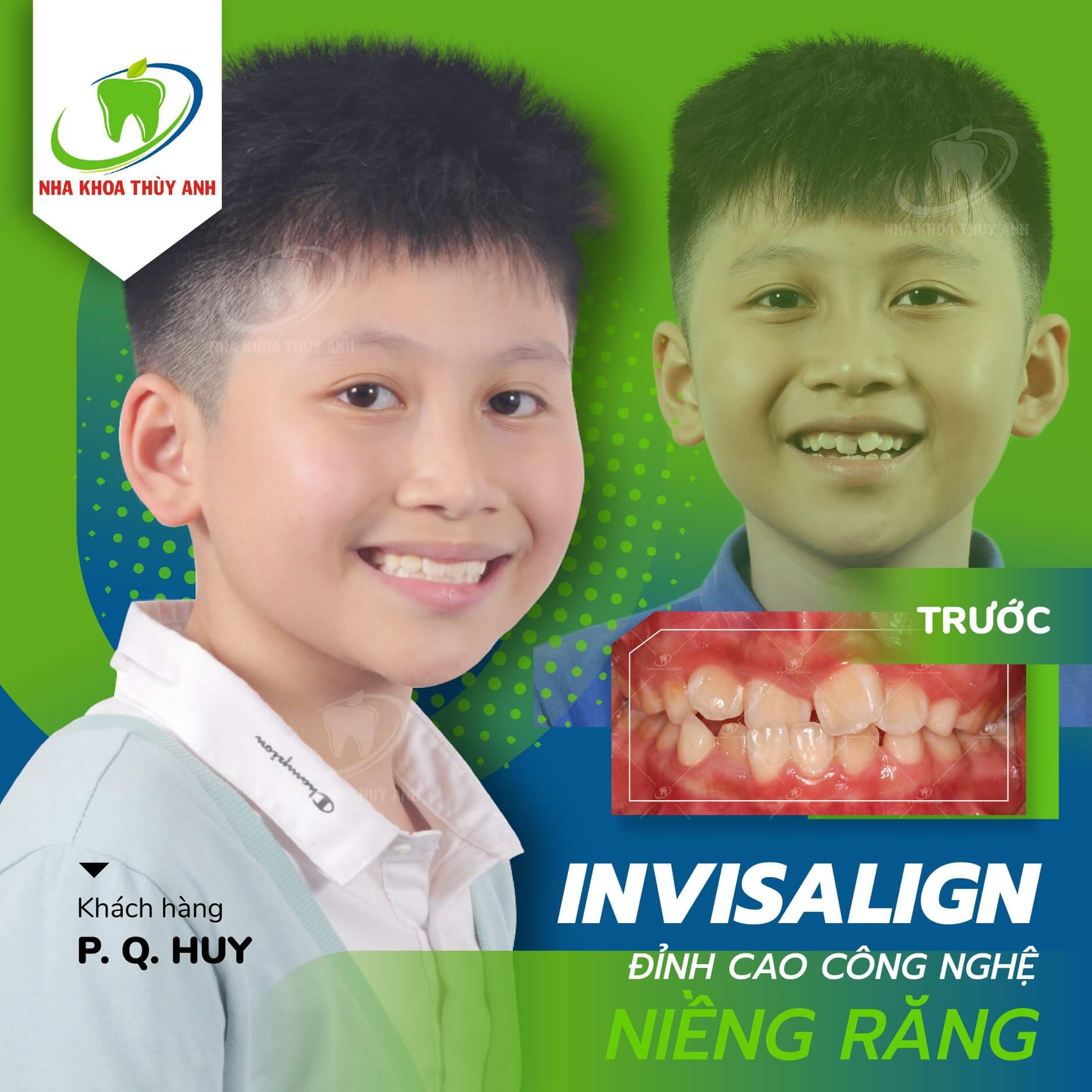 Quy trình niềng răng chuẩn quốc tế với hệ thống máng trong suốt invisalign