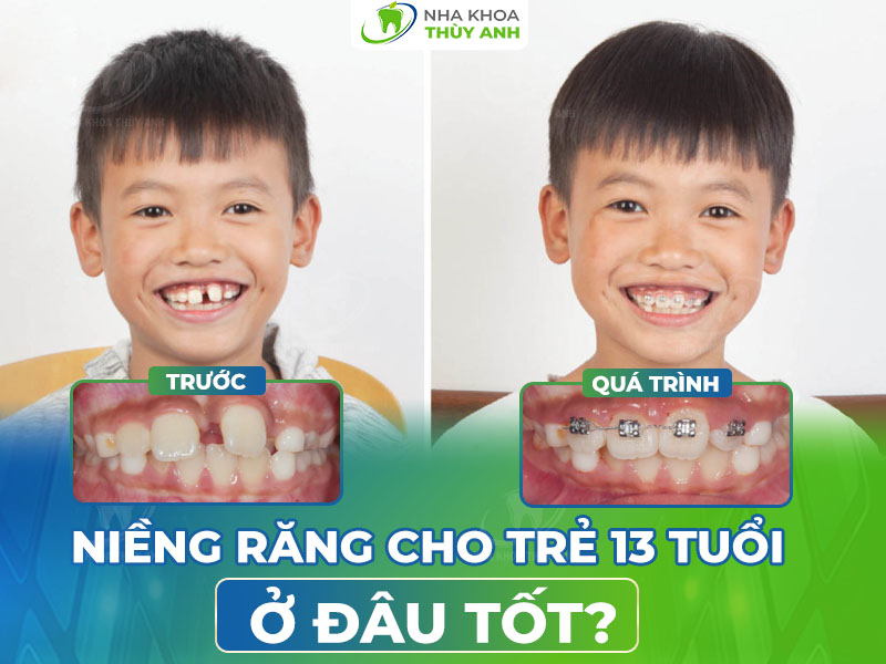 Niềng răng cho trẻ 13 tuổi ở đâu tốt nhất tại Hà Nội?