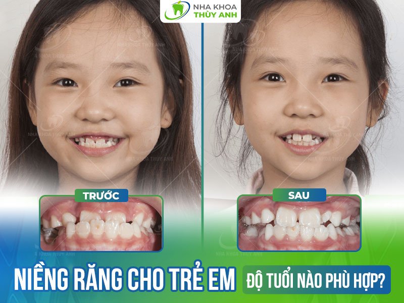 Nên niềng răng cho trẻ khi nào? Độ tuổi niềng răng cho trẻ tốt nhất
