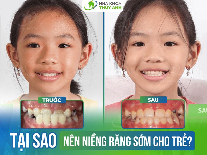 Niềng răng cho trẻ em sớm có lợi ích gì? Giá niềng răng cho trẻ em