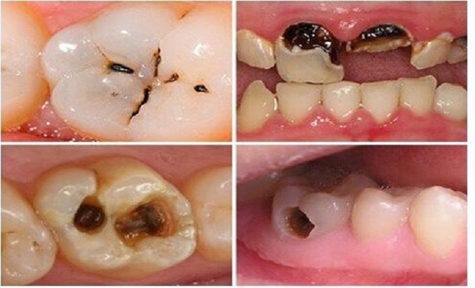 Răng gãy do bị sâu nên xử lý thế nào? Nha khoa Thùy Anh