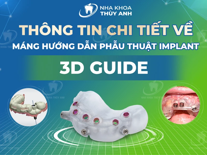 Thông tin chi tiết về máng hướng dẫn phẫu thuật implant – 3D Guide