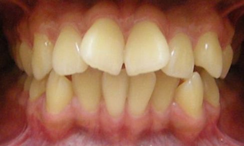 Răng cửa mọc lệch - Có nên nhổ bỏ và trồng răng mới? - nhakhoathuyanh