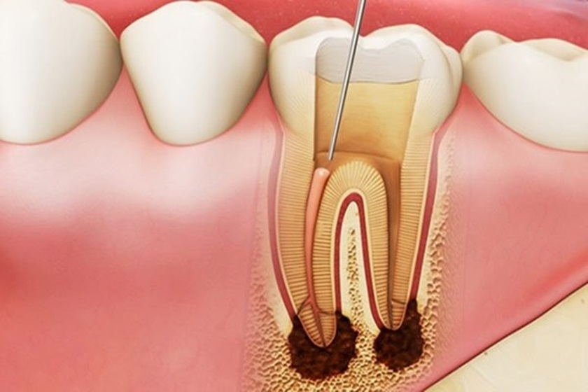 Khi răng được lấy tủy, liệu có thể tái phát bệnh tủy răng sau này không?
