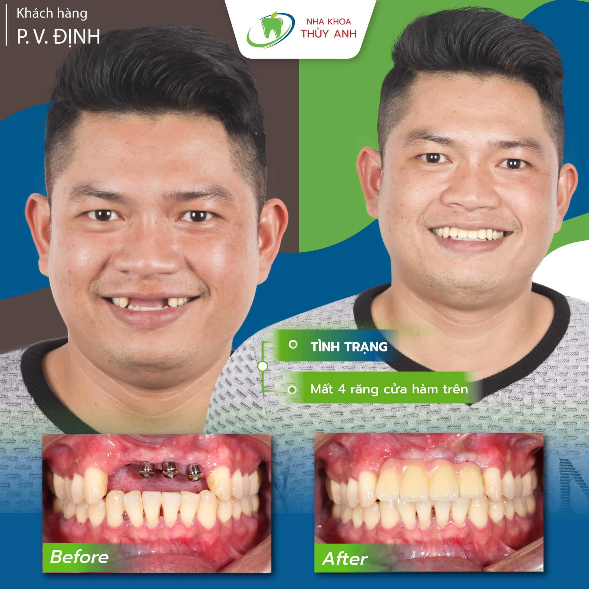 Cấy implant răng cửa giúp bạn khôi phục hàm răng hoàn hảo như trước khi bị mất răng. Bộ ảnh trước và sau khi cấy implant sẽ thuyết phục bạn tin rằng cách tốt nhất để có được nụ cười tươi mới lại là điều trị này.
