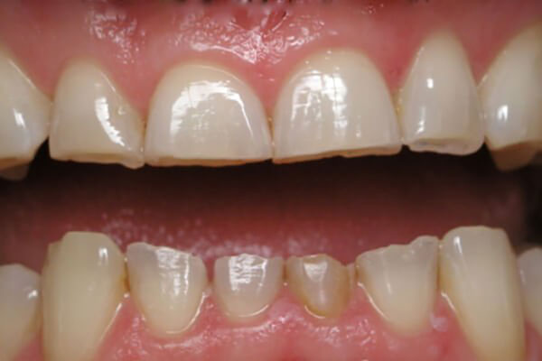 Tại sao chúng ta thương lờ đi sự mòn răng? Nha khoa Thùy Anh