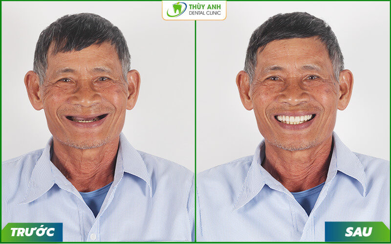 Mất răng toàn hàm – Giải pháp trồng răng an toàn, hiệu quả cho người cao tuổi