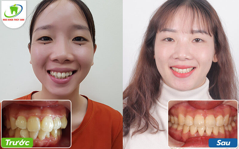 Niềng răng hô, lệch lạc giúp bạn thay đổi gương mặt thế nào? Hành trình niềng răng tìm lại sự tự tin của cô nàng 26 tuổi