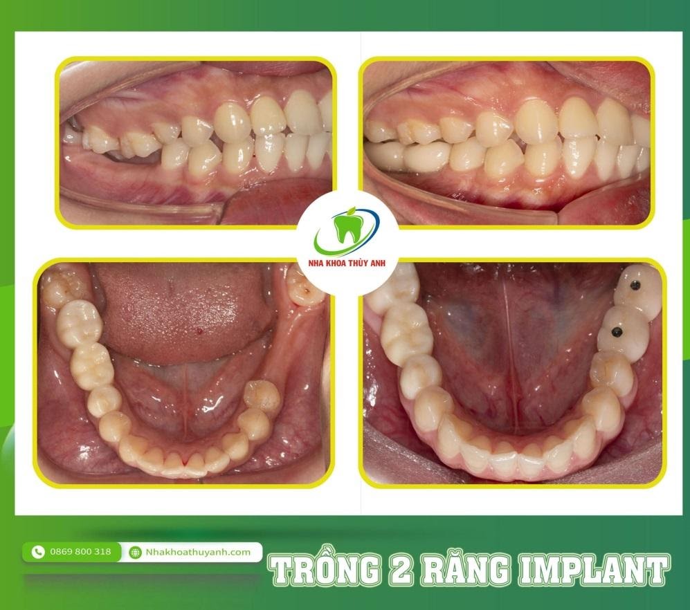Những trường hợp nên niềng răng trước khi làm răng sứ hoặc trồng răng implant