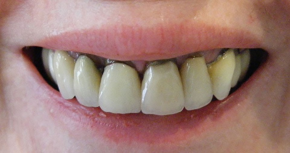 Sự hình thành của cao răng và vôi răng làm cho chân răng trở nên đen như thế nào?
