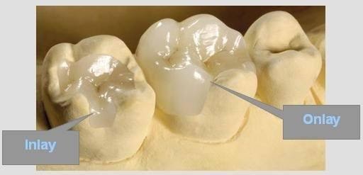 Phục hồi răng hàm sâu vỡ bằng inlay, onlay là như thế nào?