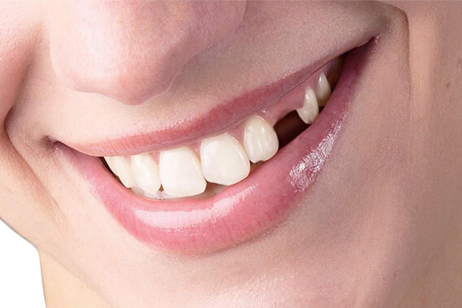 Mối nguy hại từ việc mất răng số 3 và cách khắc phục tốt nhất
