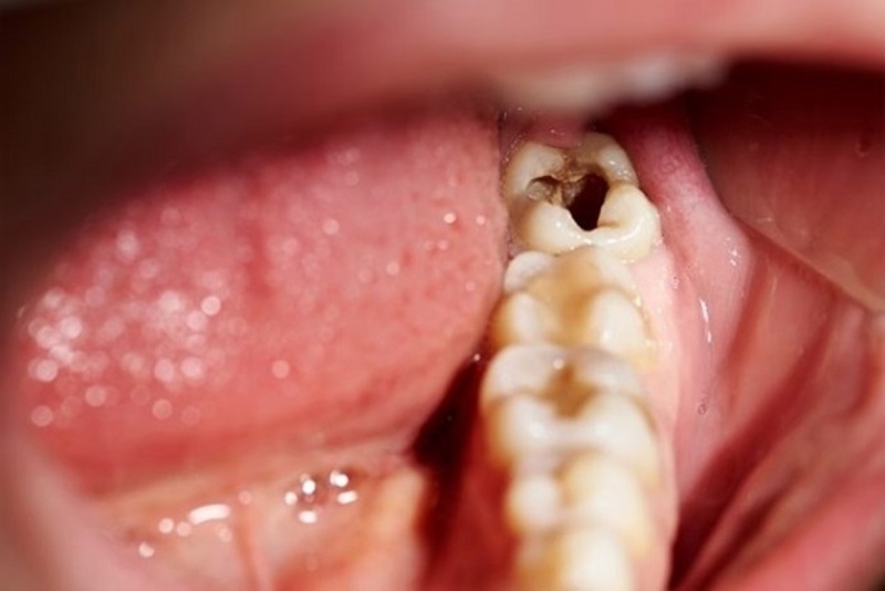 Sâu răng hàm trong cùng là răng nào? Nha khoa Thùy Anh
