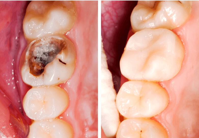 Quy trình khoan răng sâu như thế nào?
