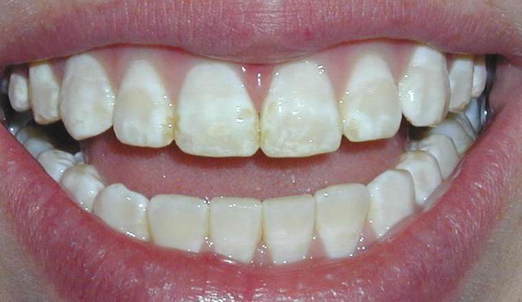  Răng xuất hiện nhiều vết rạn màu vàng nhạt hay nâu sẫm 