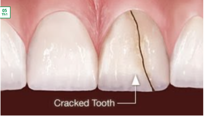 Hội chứng nứt răng và hướng điều trị bảo tồn răng thật – Nha khoa Thùy Anh