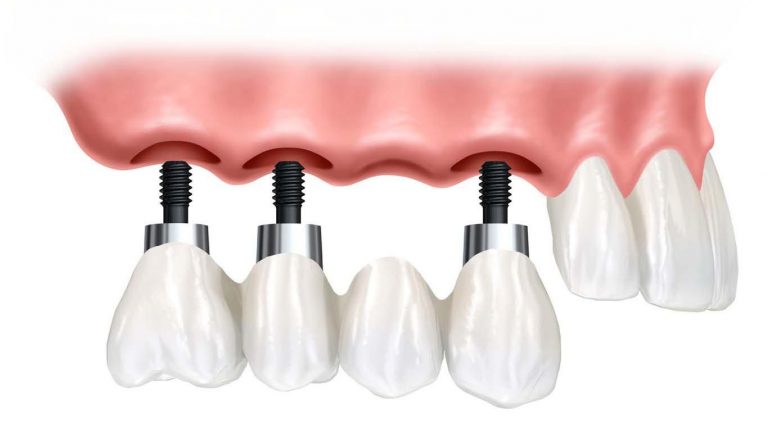 Cầu răng giả trên chân răng nhân tạo implant có chắc chắn không ...