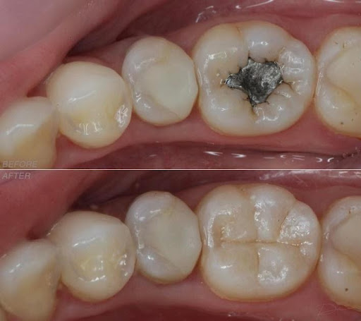 Bí quyết lựa chọn giữa bọc sứ và inlay sứ phục hồi răng sâu vỡ lớn