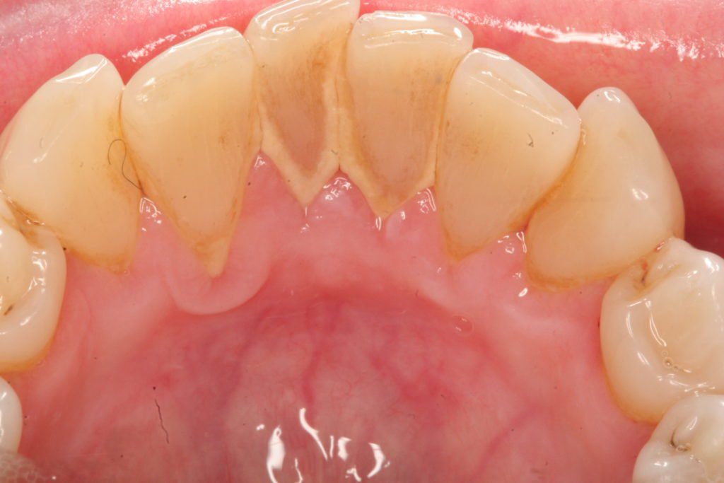 Lấy cao răng bị ê buốt có nguy hiểm không? Xử lý thế nào?