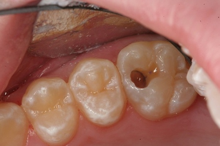 Hướng dẫn cách tự chẩn đoán tình trạng sâu răng ăn đến tủy – nha khoa Thùy Anh
