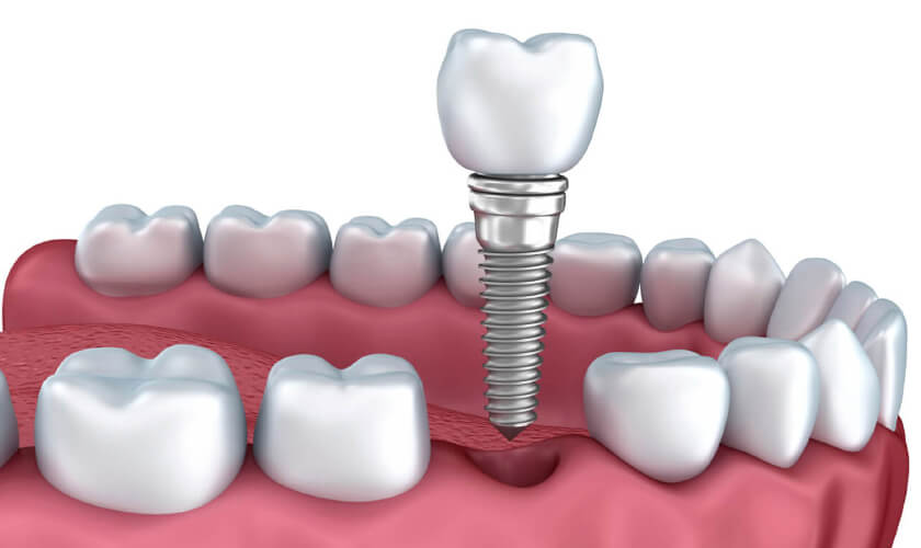 Trồng răng implant tức thì giúp rút ngắn thời gian điều trị