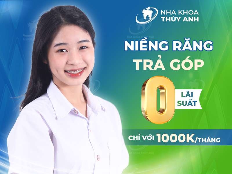 Giá niềng răng trả góp với “chi phí mềm” nhất thủ đô Hà Nội