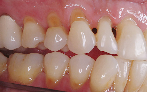 Bệnh lý mòn cổ răng: Những thông tin quan trọng cần nắm rõ
