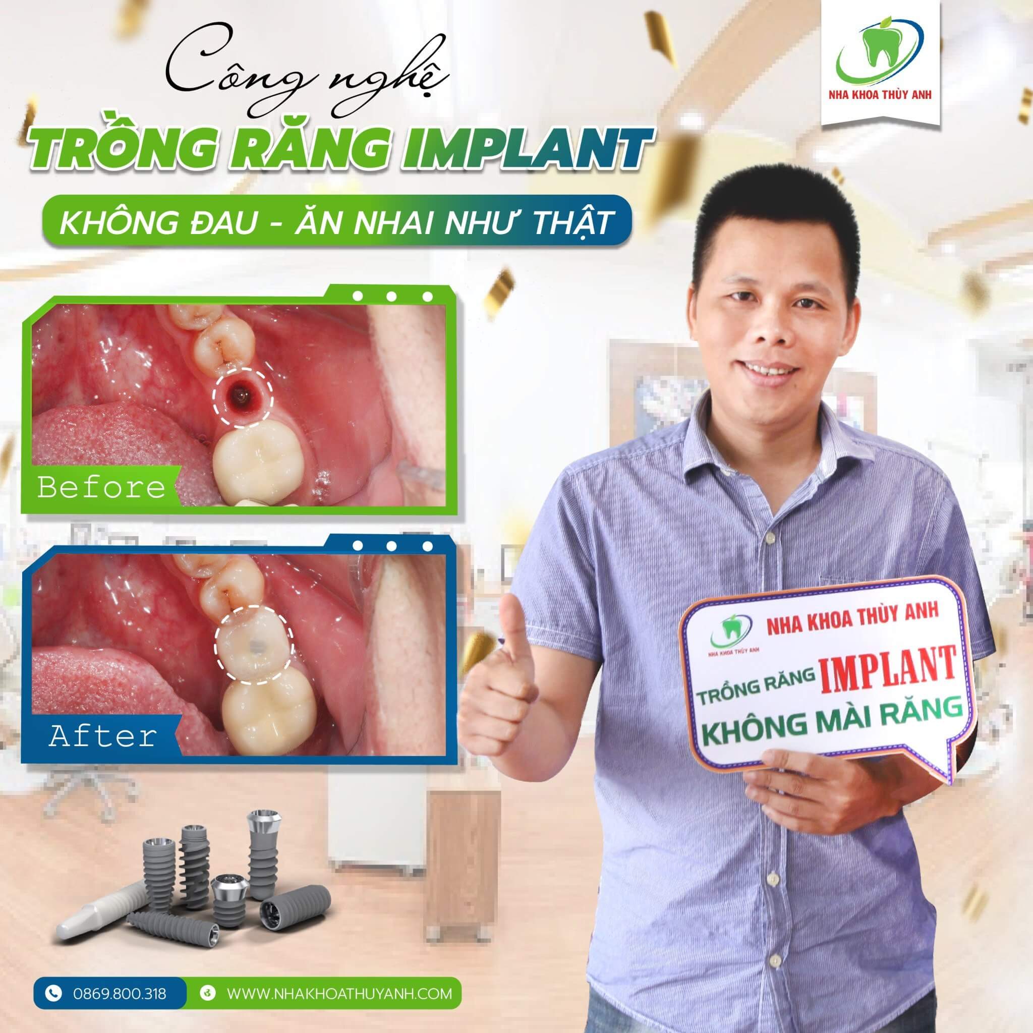 cay-ghep-implant-2 (1)