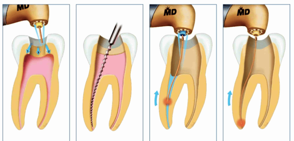 Kỹ thuật điều trị tủy lại: Hiểu rõ hơn để bảo tồn răng thật tốt hơn