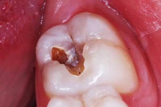 Khi nào sâu răng sẽ phá hỏng răng thật? Nha khoa Thùy Anh